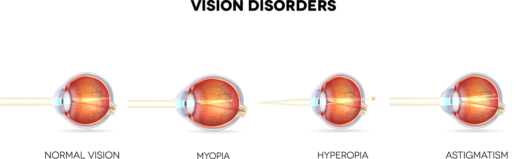 Common vision disorders treated by LASIK